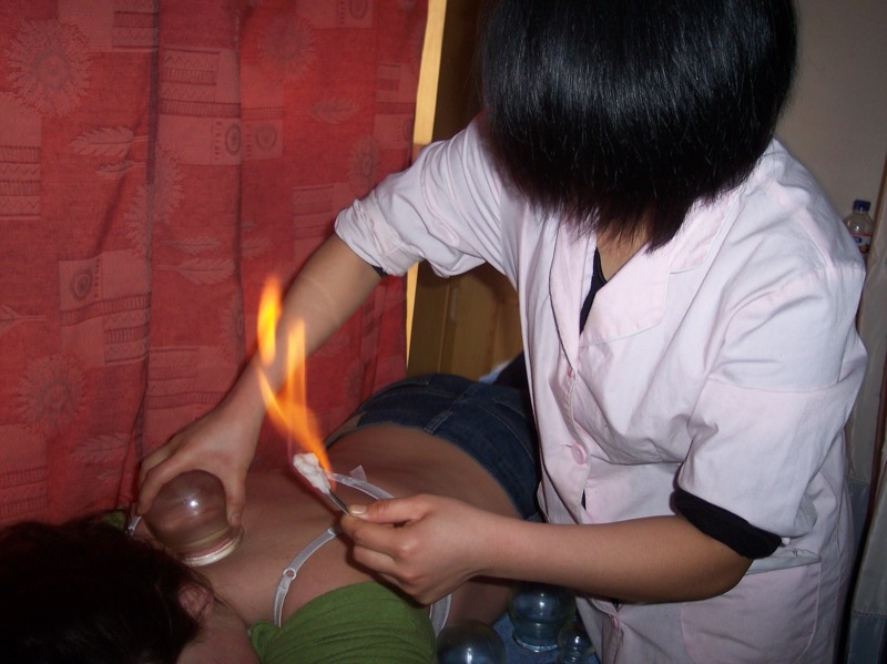 Cupping Therapy